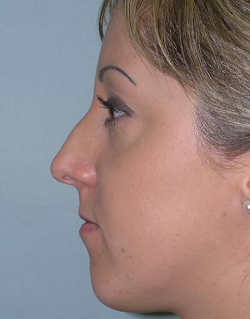 Rhinoplasty Before & After Gallery - Patient 411013 - Image 1