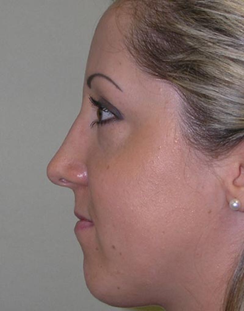 Rhinoplasty Before & After Gallery - Patient 411013 - Image 2
