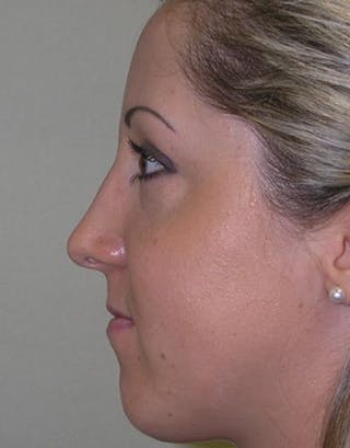 Rhinoplasty Before & After Gallery - Patient 346994 - Image 2