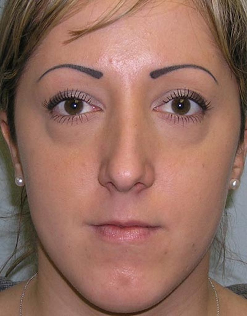 Rhinoplasty Before & After Gallery - Patient 411013 - Image 3