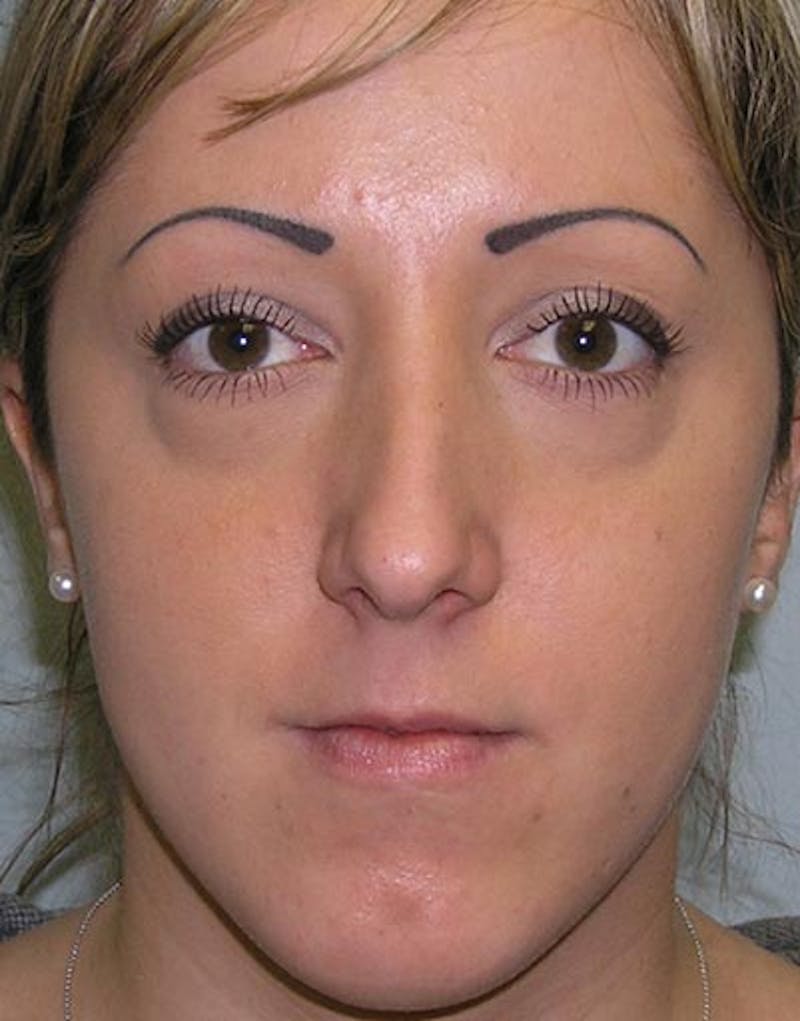 Rhinoplasty  Before & After Gallery - Patient 346994 - Image 3