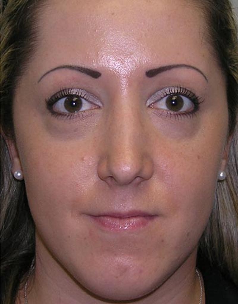 Rhinoplasty Before & After Gallery - Patient 411013 - Image 4
