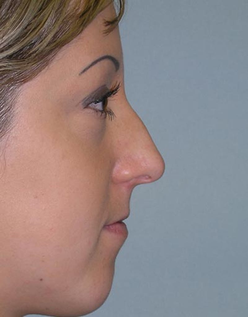 Rhinoplasty Before & After Gallery - Patient 411013 - Image 5