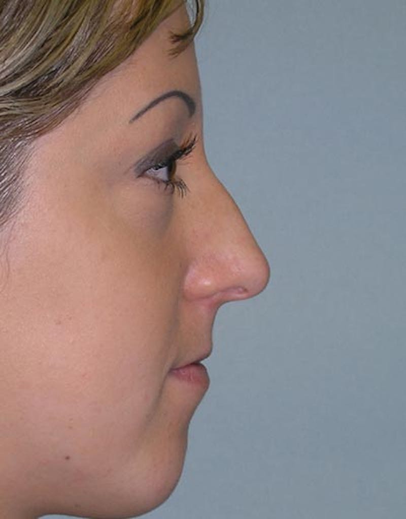 Rhinoplasty  Before & After Gallery - Patient 346994 - Image 5