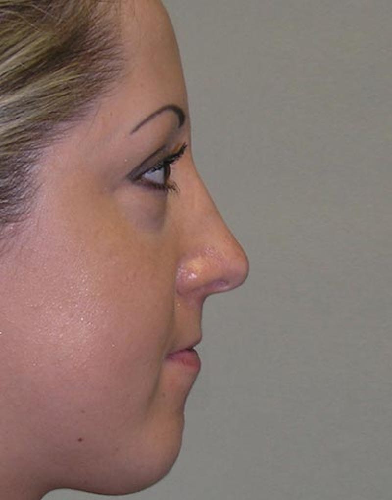 Rhinoplasty Before & After Gallery - Patient 411013 - Image 6