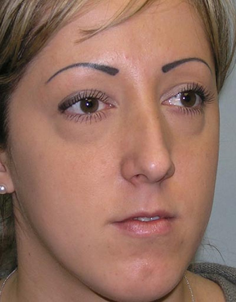 Rhinoplasty Before & After Gallery - Patient 411013 - Image 7