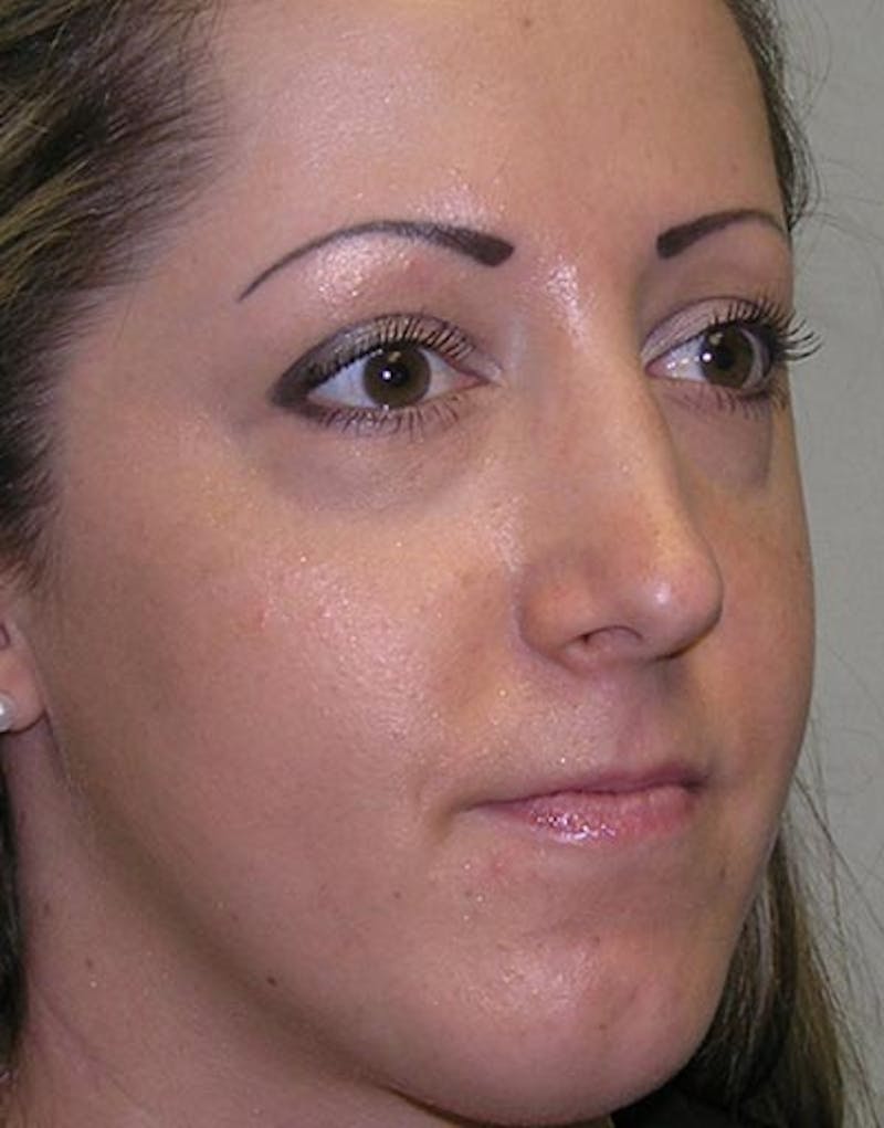 Rhinoplasty Before & After Gallery - Patient 411013 - Image 8