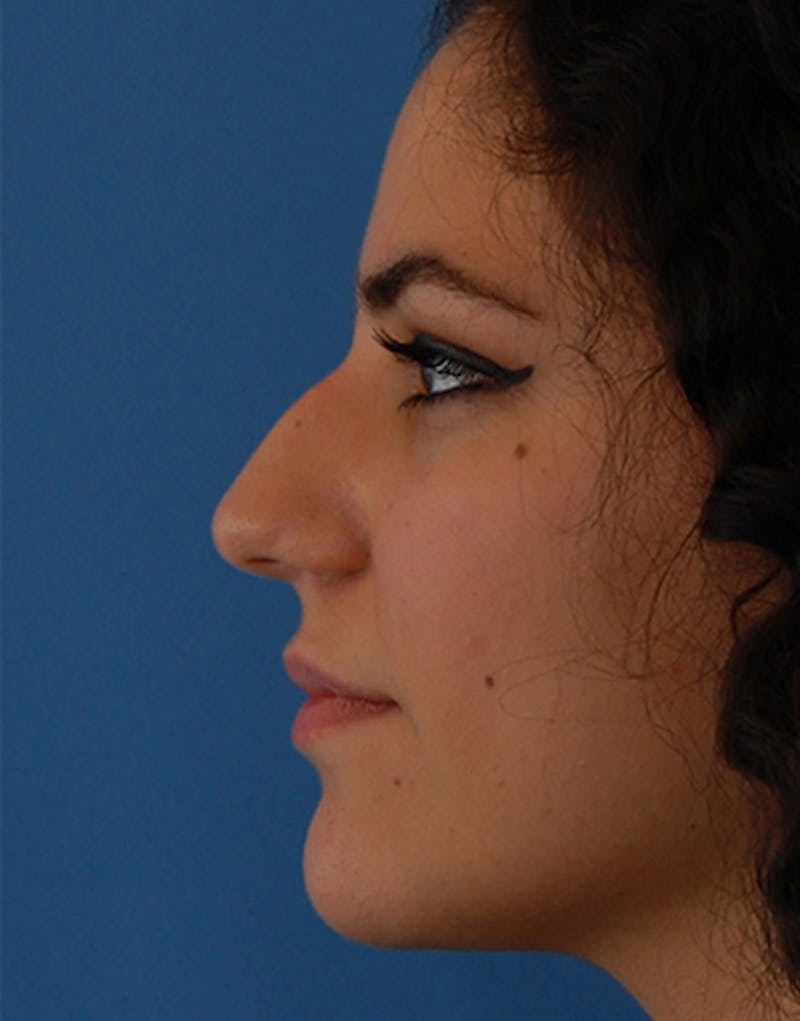 Patient T9QQCHTmT5m-aQdYOEzESg - Rhinoplasty Before & After Photos