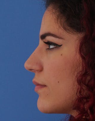Rhinoplasty Before & After Gallery - Patient 380686 - Image 2