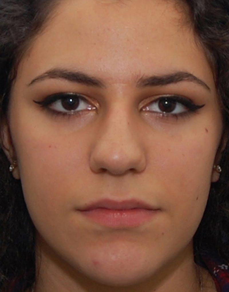 Rhinoplasty Before & After Gallery - Patient 311503 - Image 3