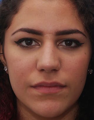 Rhinoplasty Before & After Gallery - Patient 380686 - Image 4