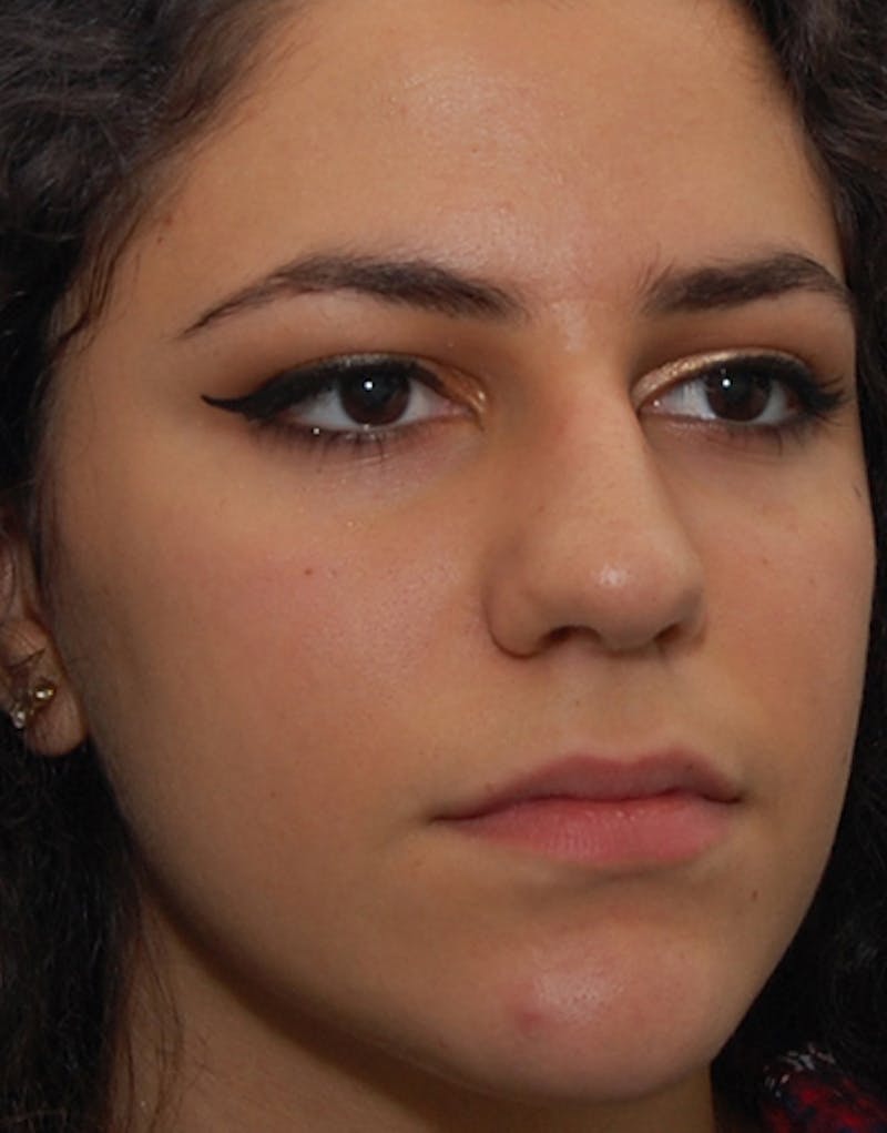 Rhinoplasty Before & After Gallery - Patient 311503 - Image 5