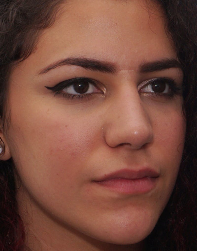 Rhinoplasty  Before & After Gallery - Patient 380686 - Image 6