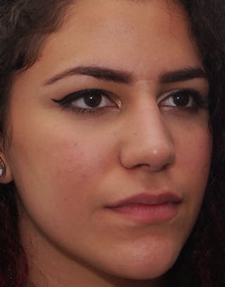 Rhinoplasty Before & After Gallery - Patient 380686 - Image 6