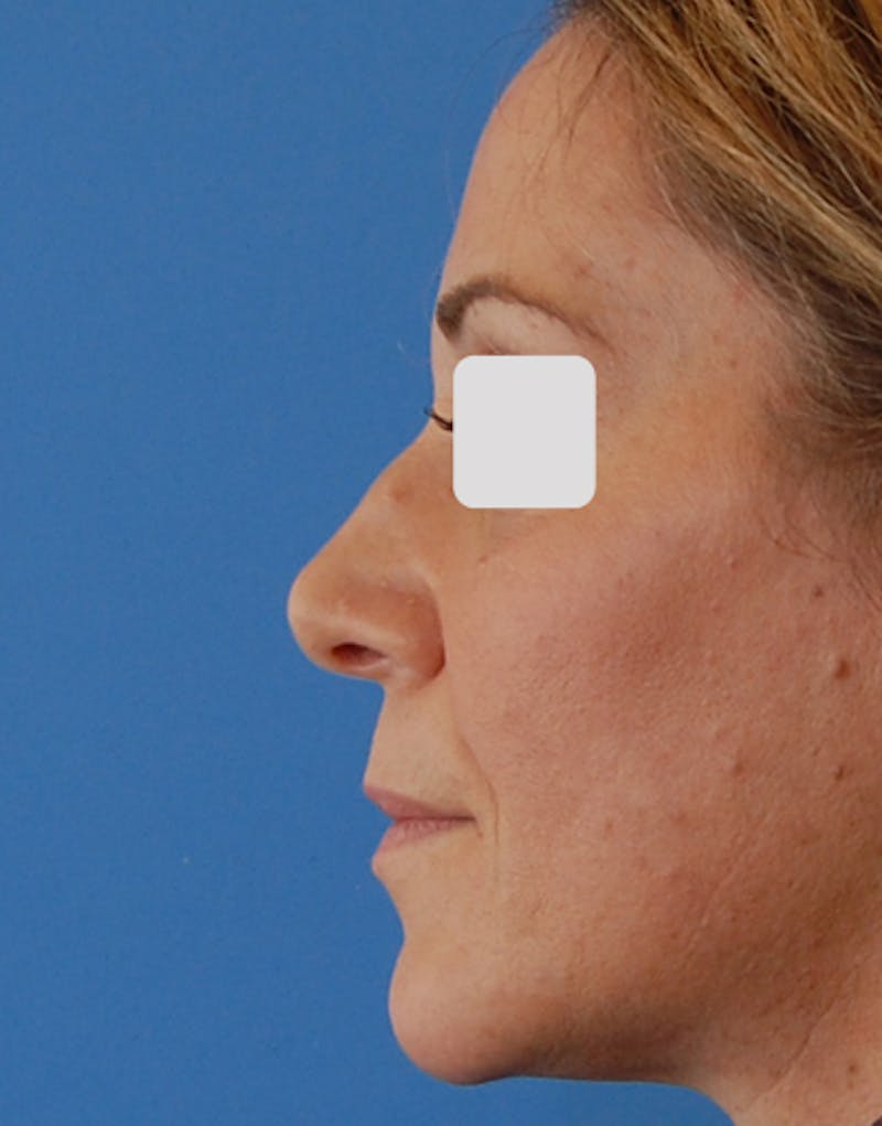 Rhinoplasty Before & After Gallery - Patient 176157 - Image 1