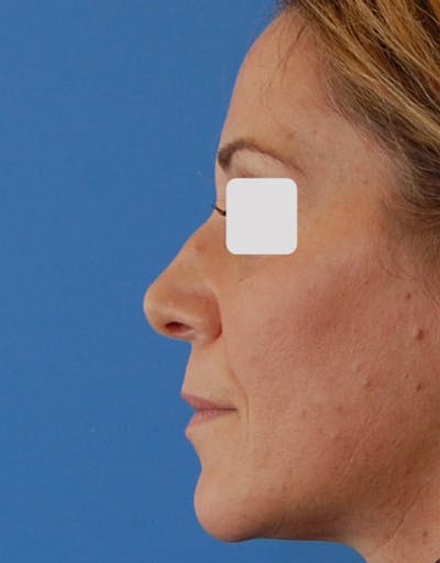 Rhinoplasty Before & After Gallery - Patient 262192 - Image 1