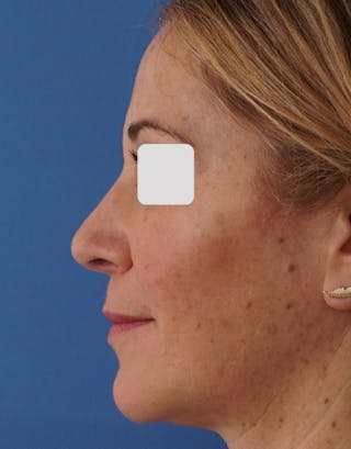 Rhinoplasty Before & After Gallery - Patient 262192 - Image 2