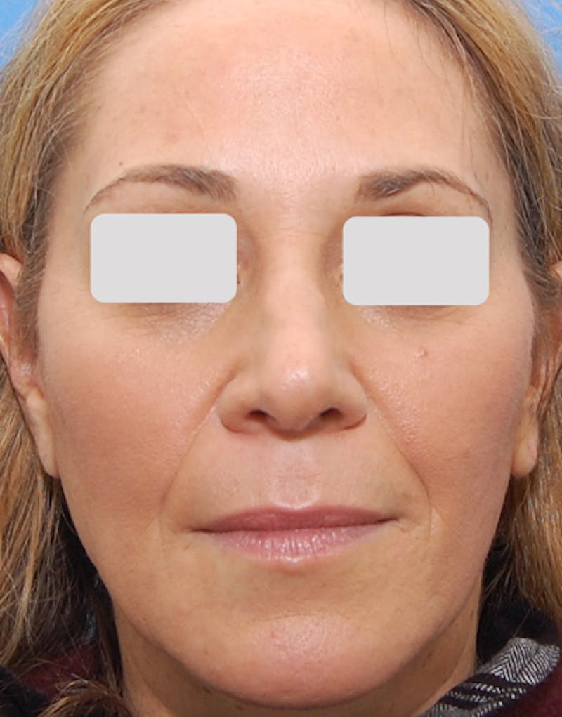 Rhinoplasty  Before & After Gallery - Patient 262192 - Image 3