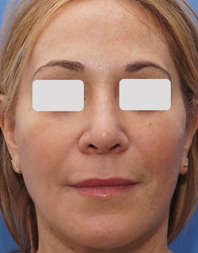 Rhinoplasty  Before & After Gallery - Patient 262192 - Image 4