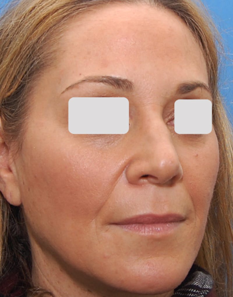 Rhinoplasty  Before & After Gallery - Patient 262192 - Image 5