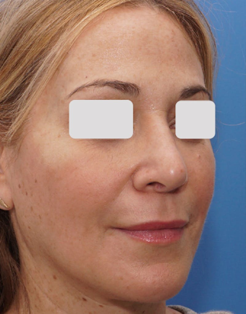 Rhinoplasty  Before & After Gallery - Patient 262192 - Image 6