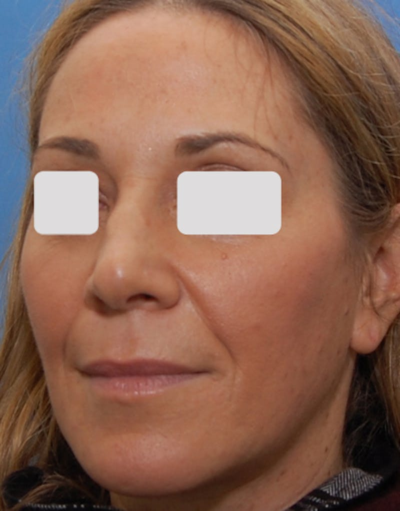 Rhinoplasty  Before & After Gallery - Patient 262192 - Image 7