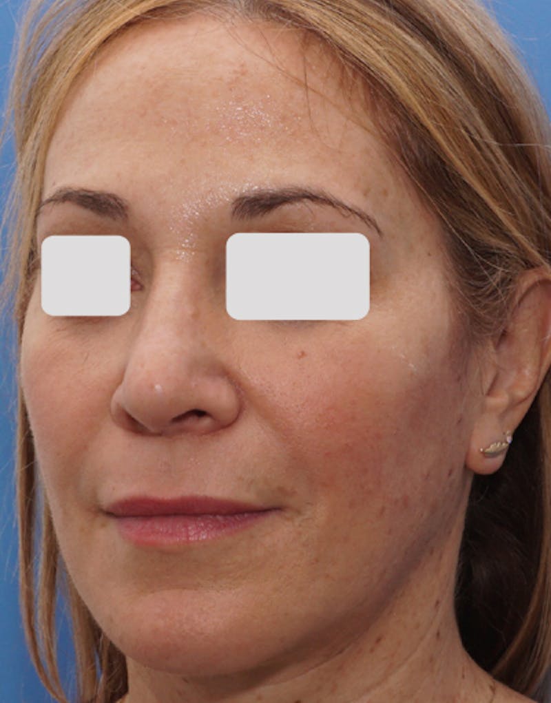 Rhinoplasty  Before & After Gallery - Patient 262192 - Image 8