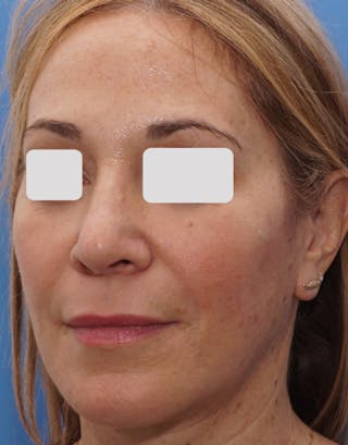 Rhinoplasty Before & After Gallery - Patient 262192 - Image 8