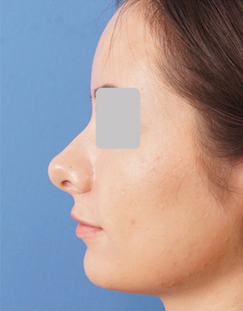 Rhinoplasty Before & After Gallery - Patient 250712 - Image 1