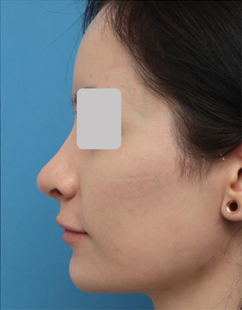 Rhinoplasty Before & After Gallery - Patient 250712 - Image 2
