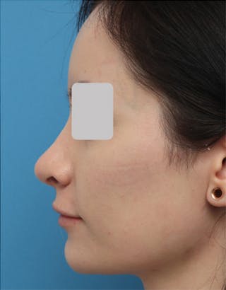 Rhinoplasty Before & After Gallery - Patient 336513 - Image 2