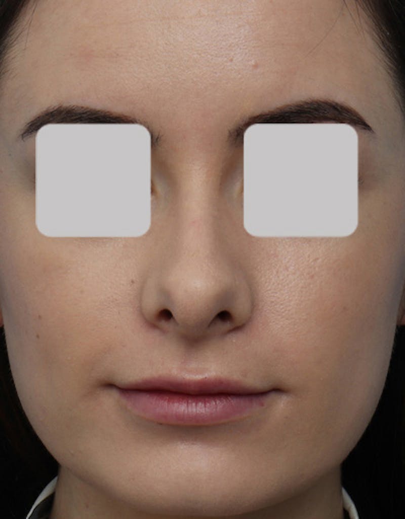 Rhinoplasty  Before & After Gallery - Patient 336513 - Image 3