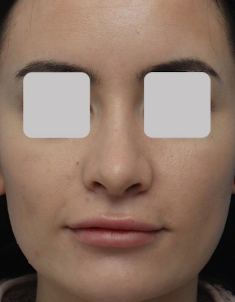 Rhinoplasty  Before & After Gallery - Patient 336513 - Image 4