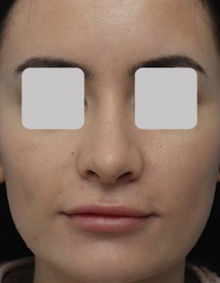 Rhinoplasty Before & After Gallery - Patient 336513 - Image 4