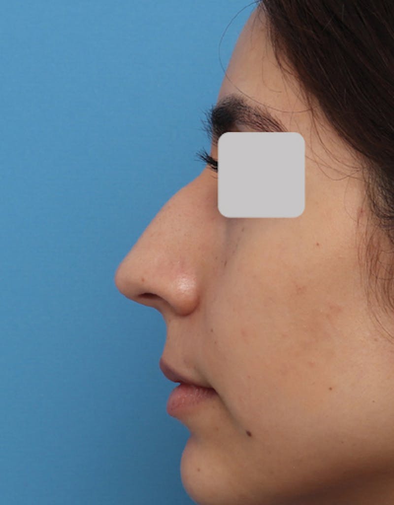 Patient XbHrqLGuSSS7oMQZm-ppnw - Rhinoplasty Before & After Photos