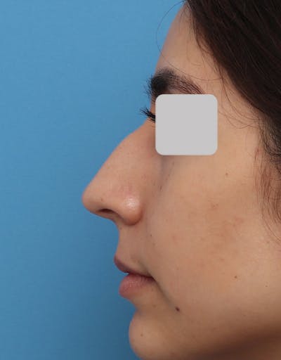 Rhinoplasty Before & After Gallery - Patient 178172 - Image 1