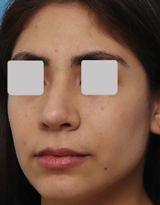 Rhinoplasty Before & After Gallery - Patient 178172 - Image 6