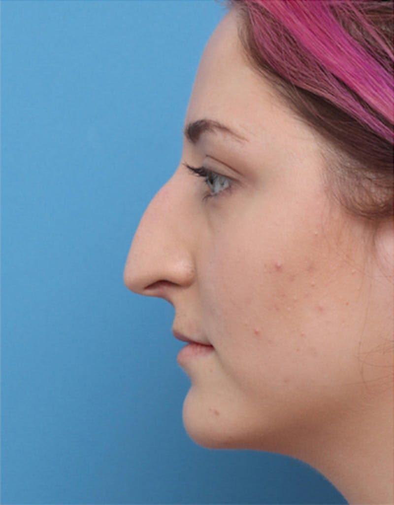 Rhinoplasty Before & After Gallery - Patient 255437 - Image 1