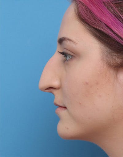 Rhinoplasty Before & After Gallery - Patient 177739 - Image 1