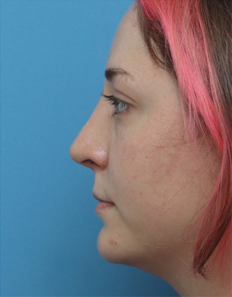 Rhinoplasty Before & After Gallery - Patient 255437 - Image 2