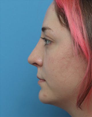 Rhinoplasty Before & After Gallery - Patient 177739 - Image 2