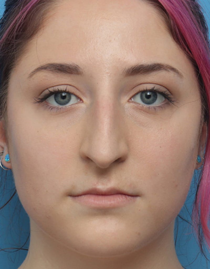 Rhinoplasty Before & After Gallery - Patient 255437 - Image 3