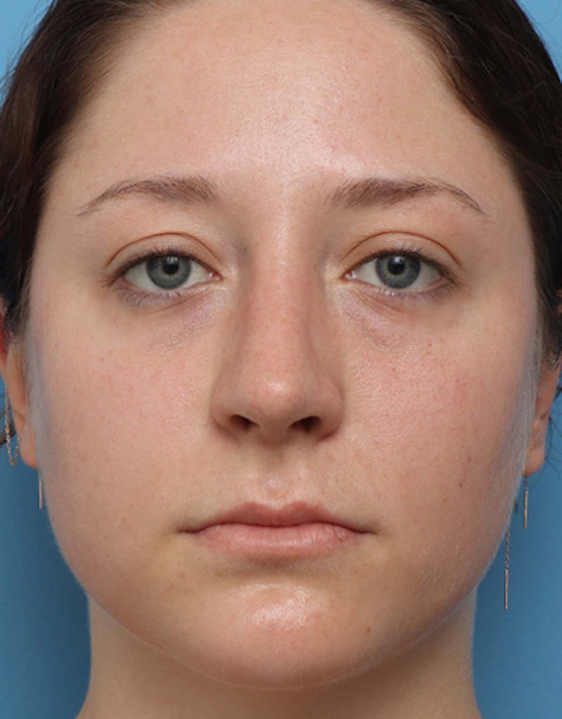 Rhinoplasty Before & After Gallery - Patient 255437 - Image 4