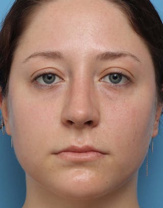 Rhinoplasty Before & After Gallery - Patient 177739 - Image 4
