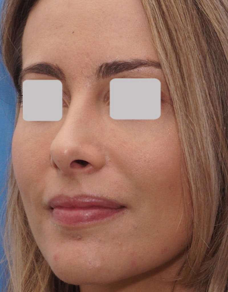 Favorite Revision Rhinoplasty Before & After Gallery - Patient 292560 - Image 5