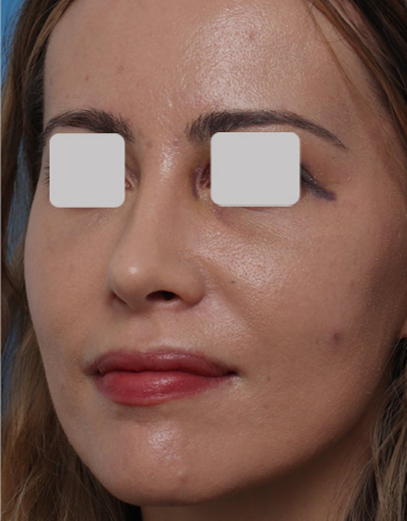 Favorite Revision Rhinoplasty Before & After Gallery - Patient 292560 - Image 6