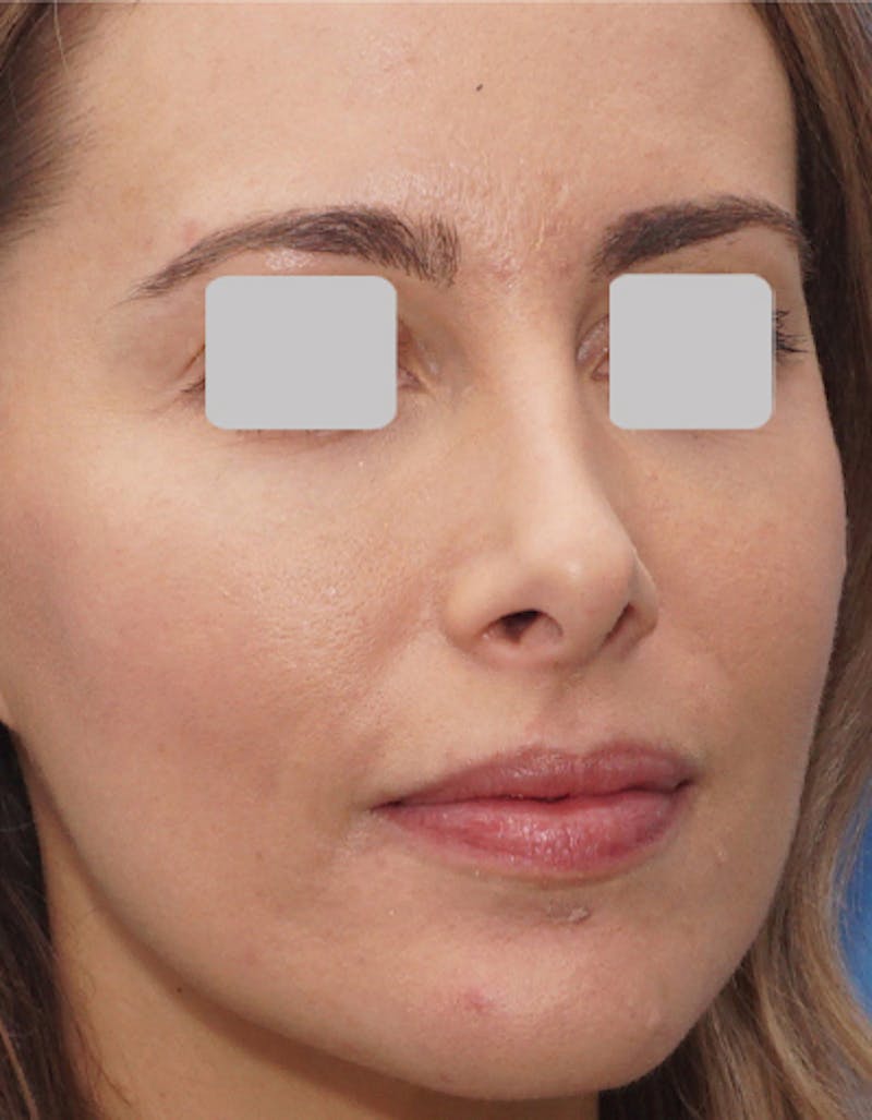 Favorite Revision Rhinoplasty Before & After Gallery - Patient 292560 - Image 7