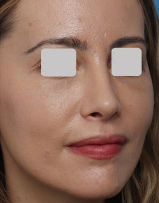 Favorite Revision Rhinoplasty Before & After Gallery - Patient 292560 - Image 8