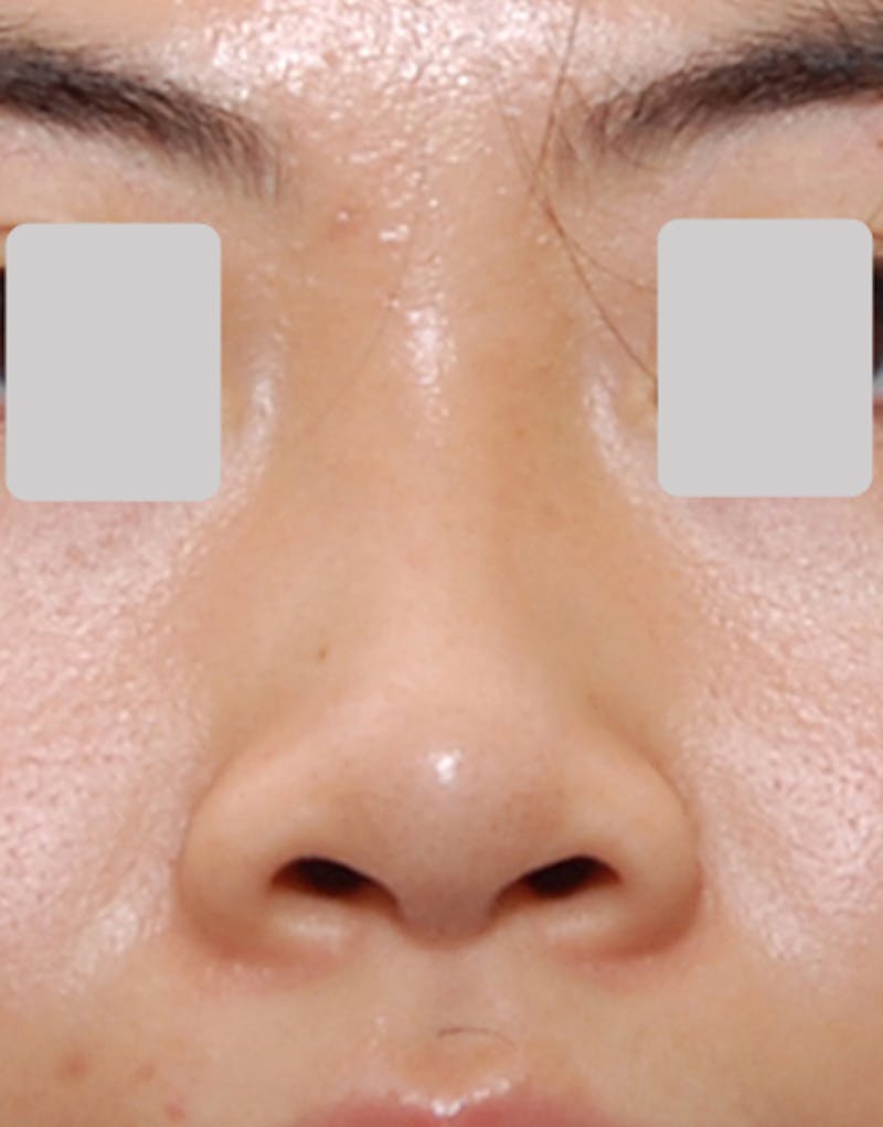 Patient RgzdM98RQgKgMwx-yz-s4A - Ethnic Rhinoplasty Before & After Photos