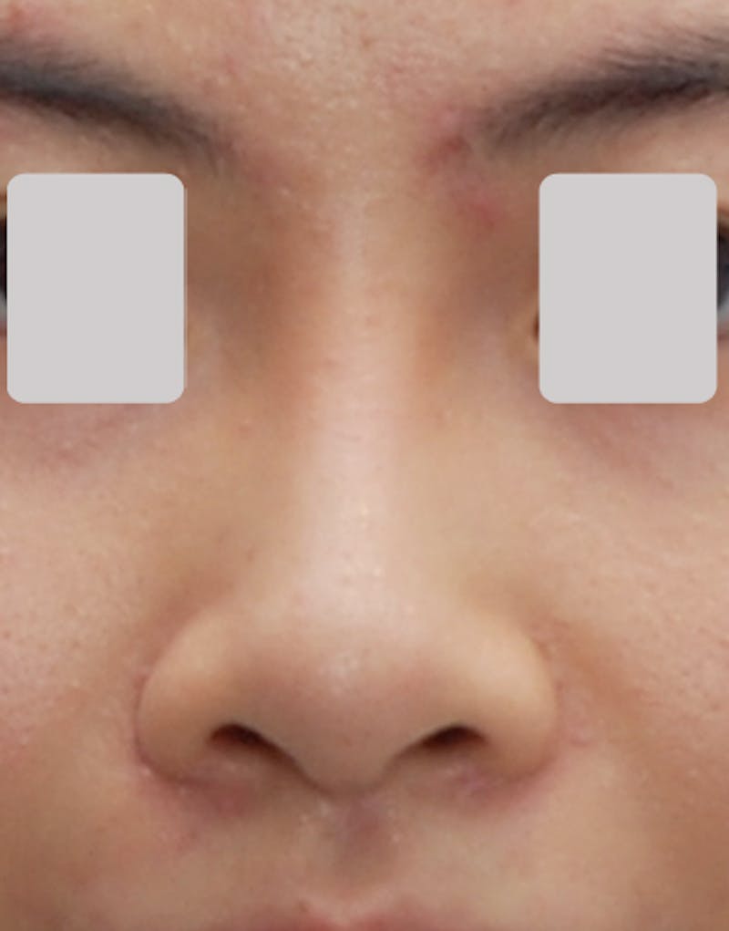 Rhinoplasty Before & After Gallery - Patient 320193 - Image 2